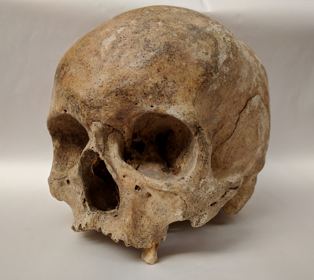 Skeletal remains showing evidence of leprosy from the Odense St. Jørgen cemetery in Denmark, which was established in 1270 and existed until 1560.